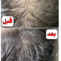 رویش مو (پی ارپی ، مزوتراپی )