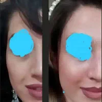 بوتاکس/فیلر صورت/کلینیک فرسیما/بوتاکس/نخ