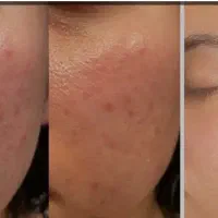 فشیال تخصصی vip پوست به مدت 3 روز فقط 170 تومن|خدمات آرایشگری و زیبایی|مشهد, آزادشهر|دیوار