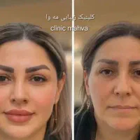 فیلر بوتاکس آنزیم مزوتراپی مزونیدل پلاسما جوانسازی