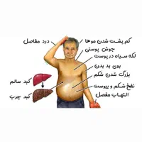 *درمان. کبدچرب|آرایشی، بهداشتی، درمانی|اصفهان, عباسآباد|دیوار
