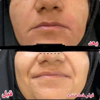 تزریق ژل و مزو وبوتاکس