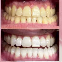 لبخند هالیوددی با بلیچینگ و فقط در یک جلسه