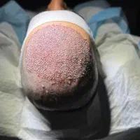 کاشت مو تضمینی با شرایط عالی در سقز