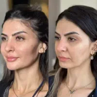 پایان جستجوکلینیک تخصصی پوست نخ ژل هایفو آموزش ژل|خدمات آرایشگری و زیبایی|تهران, زعفرانیه|دیوار