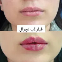 بوتاکس ژل فیلر فیلربادی مزوتراپی پی آر پی در مطب