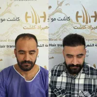 کاشت مو،کاشت ابرو،کاشت ریش با شرایط استثنایی