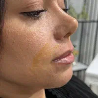 تزریق ژل بوتاکس فیلر بادی آنزیم بینی آنزیم