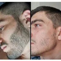 تضمینی ریشاتو پر پشت کن