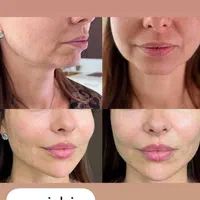 ژل لب ،زاویه سازی،فیلر چانه ،فول فیس|خدمات آرایشگری و زیبایی|مشهد, سجاد شهر|دیوار