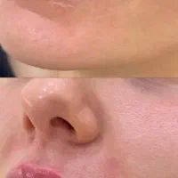 بوتاکس چشم گربه ای 500 ژل لب روسی عروسکی 500