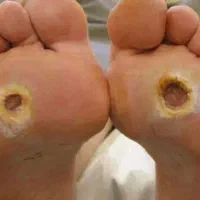 درمان نوین انواع زخم دیابتیک و بستر و جراحی و بخیه|خدمات آرایشگری و زیبایی|صومعهسرا, |دیوار