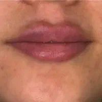 ژل و بوتاکس 550آموزش4م.باکمترین هزینه بدرخشید.|خدمات آرایشگری و زیبایی|شهریار, شهریار|دیوار