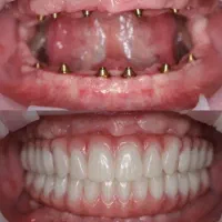 دندان پزشکی ایمپلنت در حد آلمانی +روکش،اقساطی
