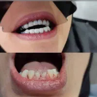 لمینت مترحک دندان اصل|آرایشی، بهداشتی، درمانی|ایلام, |دیوار