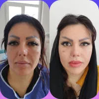 لیفت شقیقه وگونه با جراحی|خدمات آرایشگری و زیبایی|بوکان, |دیوار