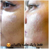 برداشتن خال.زگیل تناسلی.جای زخم و بخیه. میخچه|خدمات آرایشگری و زیبایی|کرمانشاه, |دیوار