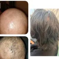 جشنواره لیفت شقیقه و ابدومینوپلاستی مرکز جراحی الی|خدمات زیبایی و سلامت|تهران, بهجتآباد|دیوار