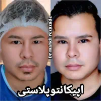 ساکشن شکم ترنسفر تزریق بلفارو اپیکانتوپلاستی|خدمات آرایشگری و زیبایی|مشهد, هفت تیر (حافظ)|دیوار