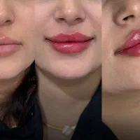 ژل و بوتاکس|خدمات آرایشگری و زیبایی|قم, باجک یک|دیوار