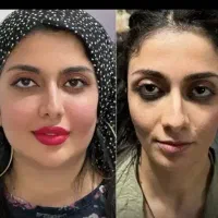 ژل فیلر بوتاکس لیفت چانه لب گونه شقیقه کلینیک