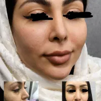 تخفیف تزریق چربی پایین ترین قیمت فقط به مدت محدود|خدمات آرایشگری و زیبایی|کرج, گوهردشت|دیوار