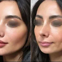 جشنواره پاییزه تزریق ژل و بوتاکس|خدمات آرایشگری و زیبایی|اصفهان, رزمندگان|دیوار