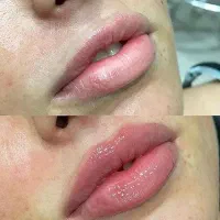 تزریق ژل لب و بوتاکس و مزوتراپی مو‌