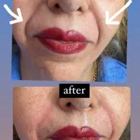 مزو ژل بوتاکس انزیم بینی پلکسرپیرسینگ پاکسازی|خدمات آرایشگری و زیبایی|پرند, فاز ۵|دیوار