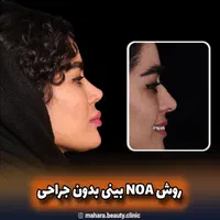 فرم دهی بینی بدون جراحی و بیهوشی رینوپلاستی NOA|خدمات آرایشگری و زیبایی|مشهد, هفت تیر (حافظ)|دیوار