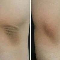 ازبین بردن تیرگی ،ازبین بردن ترک عمیق پا|خدمات آرایشگری و زیبایی|بوشهر, |دیوار