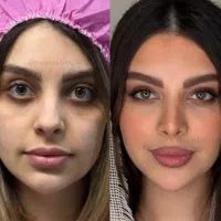 عمل جراحی بینی فقط ۳۵ میلیون/لیفت صورت|خدمات زیبایی و سلامت|کرج, فاز ۲ مهرشهر|دیوار