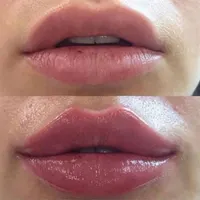 ژل بوتاکس نخ لیفت مزو زاویه|خدمات آرایشگری و زیبایی|تهران, سلسبیل|دیوار