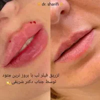 جشنواره ۵۰ درصدی ژل و بوتاکس توسط جناب دکتر شریفی|خدمات آرایشگری و زیبایی|قم, بلوار امین و ساحلی|دیوار