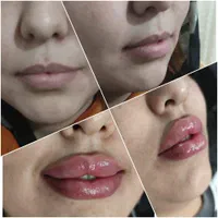 بوتاکس ژل لیزربلفارو لاغری تبریزسهندمطب میری