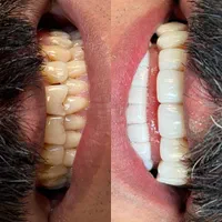 لبخند هالیوودی|خدمات آرایشگری و زیبایی|قم, زنبیل آباد|دیوار
