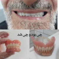 چی بود و چی شد دندان مصنوعی