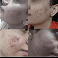 درمان جوش با هر منشایی|خدمات آرایشگری و زیبایی|دوگنبدان, |دیوار