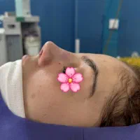 عمل بینی فقط با ۲۵ تومن تا پایان مهر ماه در تهران|خدمات آرایشگری و زیبایی|قم, بکایی|دیوار