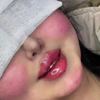 انجام کلیه ژل و بوتاکس ب صورت تخصصی