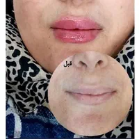 جشنواره ژل و بوتاکس|خدمات آرایشگری و زیبایی|تهران, هفت حوض|دیوار