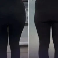 تزریق بوتاکس .ژل صورت .فیلر بادی . انزیم غبغب