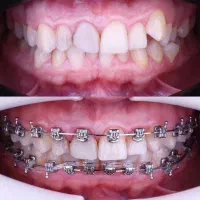 ارتودنسی دندان با شرایط ویژه