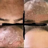 رفع تیرگی،آلگاپیل،لک صورت، پرسینگ، ژل صورت