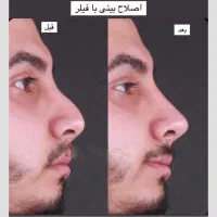 تزریق فیلر بادی کانتورینگ صورت بوتاکس ژل لب|خدمات آرایشگری و زیبایی|تهران, جردن|دیوار
