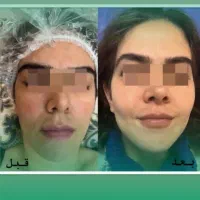 تزریق چربی به تمام نواحی|خدمات آرایشگری و زیبایی|قزوین, |دیوار