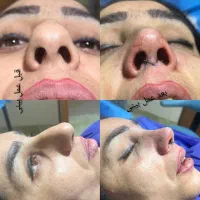 عمل زیبایی بینی با بهترین متد|خدمات آرایشگری و زیبایی|کرج, اتحاد|دیوار
