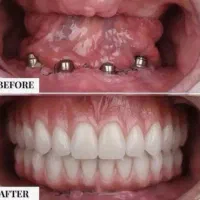 جشنواره پاییزه کامپوزیت،لمینیت،ایمپلنت اقساط|خدمات آرایشگری و زیبایی|بومهن, |دیوار