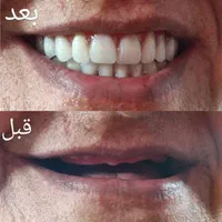 دندانسازی خیریه طرح لمینت|خدمات آرایشگری و زیبایی|مشهد, عامل|دیوار