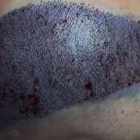 کاشت مو و ابرو|خدمات آرایشگری و زیبایی|سراب, |دیوار